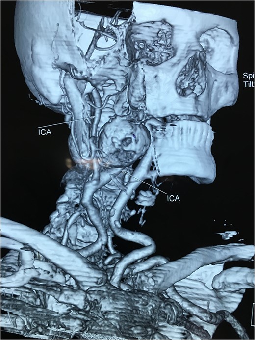 Computed tomography angiography of the carotids with 3D reconstruction.