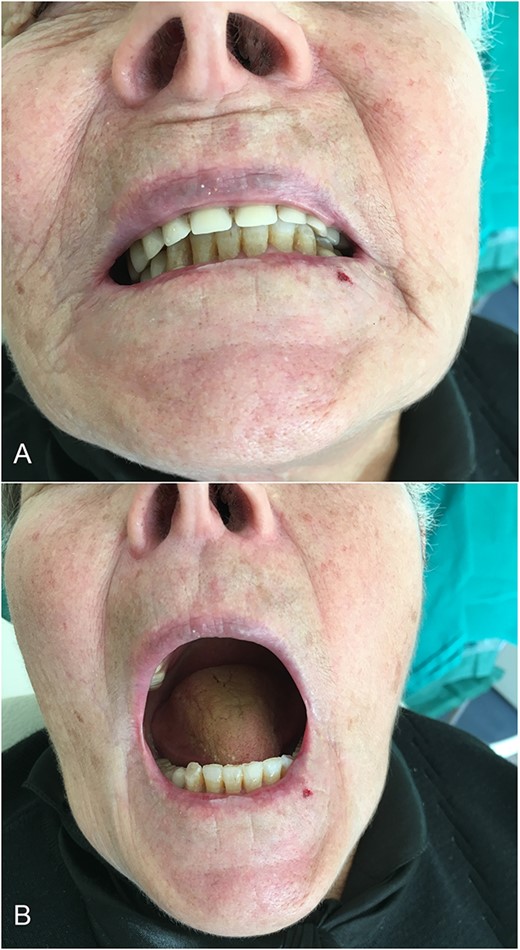 Post-operative mouth opening, and occlusion are normal.