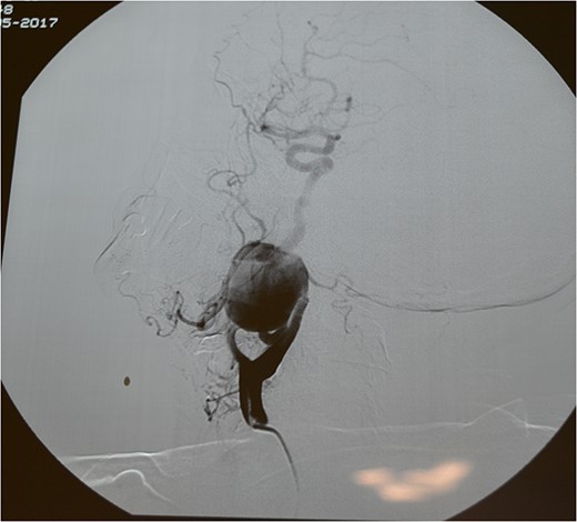 Classical angiography.