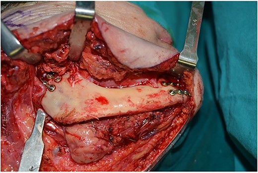 Preplating of two miniplates with four holes, in the parasymphysis and in the subcondylar area.