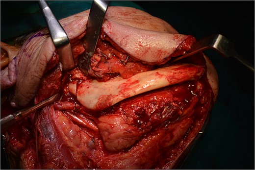 Osteotomy in the parasymphysis and the subcondylar area, after removal of the preplated miniplates.