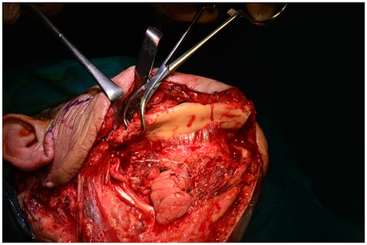 The mandibular ‘swing’.