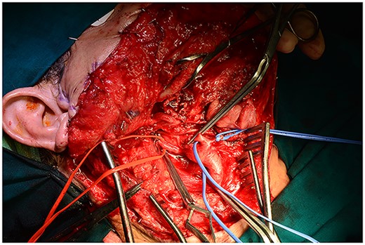 All the branches of the carotid artery are demonstrated prepared, and the aneurysm is demonstrated.