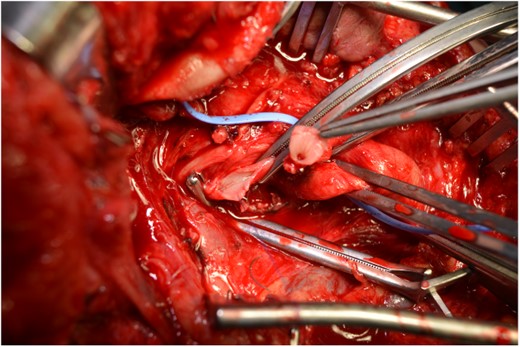The step before the end-to-end anastomosis of the external carotid artery with the healthy peripheral end of the internal carotid near to the skull base.