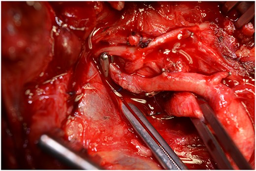 The anastomoses were checked for leakage.