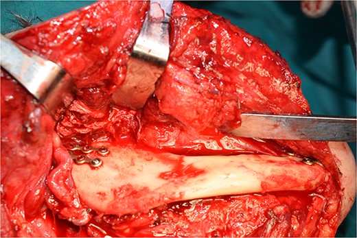 The mandible back in place and the rigid internal fixation.