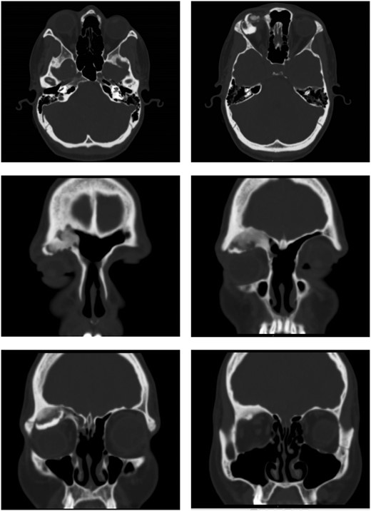 Ossifying fibroma in the right frontal sinus involving anterior and lateral frontal sinus walls, and orbital floor.