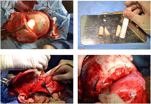 Combined endoscopic and bicoronal approach with the cadaveric rib graft cut to size to fit and repair the orbital floor defect.