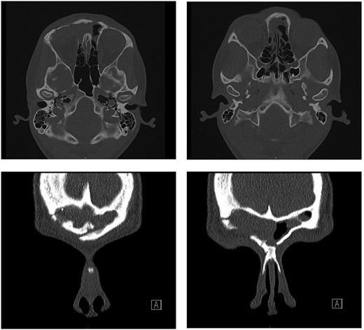 Repeat CT scan at 4 months after surgery, demonstrating no residual disease and radiological improvement of proptosis.