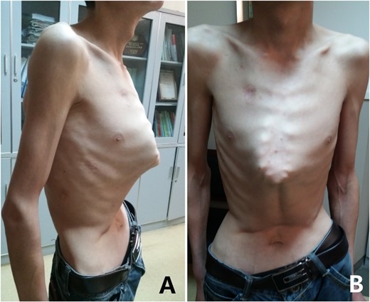 Appearance of chest wall before operation. (A) Lateral view; and (B) front view.