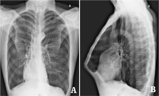 X-ray examination before operation. (A) Posteroanterior radiograph; and (B) lateral radiograph.