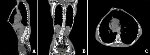 Computed tomography examination before operation. (A) Sagittal view; (B) coronal view; and (C) sectional view.