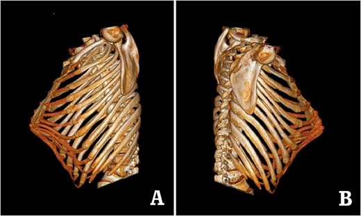 Preoperative 3D reconstruction pictures. (A) Left side view;and (B) right side view.