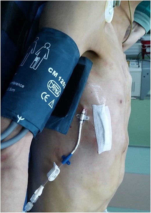 Appearance of chest wall after operation.