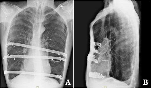 X-ray examination after operation. (A) Posteroanterior radiograph; and (B) lateral radiograph.