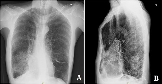 X-ray examination after the bars were taken out. (A) Posteroanterior radiograph; and (B) lateral radiograph.