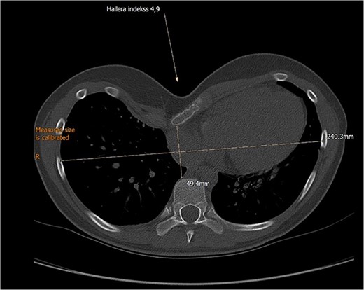 Preoperative computed tomography demonstrating severe pectus excavatum with Haller’s index 4.9.