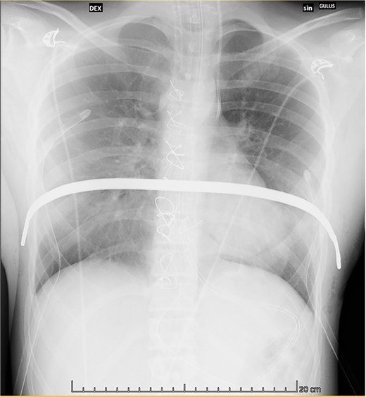 Postoperative chest X-ray showing the correct positioning of the bar.