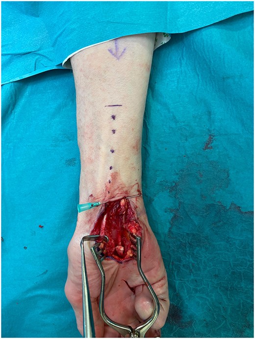 Intra-operative photo showing complete rupture of the FDP tendon with obvious gapping between the two ends.