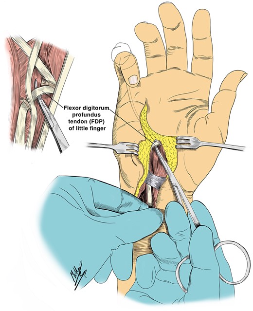 A medical illustration showing the scarring found in the second operation with change in the direction of pull of the FDP tendon acting as valve like mechanism. Illustrated by Miller Rasmy.