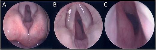 (A) Endoscopic (MLB) photographs of the supraglottic region. (B–C) Endoscopic (MLB) photographs of glottic and subglottic regions highlighting the presence of a subglottic haemangioma.