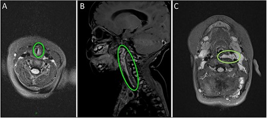 (A) MRI scan highlighting the subglottic infantile haemangioma. (B–C) Sagittal and axial MRI images of the carotid sheath haemangioma.