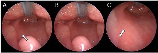 (A–C) Intra-operative endoscopic photographs highlighting the left sided asymmetric parapharyngeal fullness immediately inferior to the inferior pole of the left tonsil where the biopsy was undertaken and macroscopically abnormal tissue identified.
