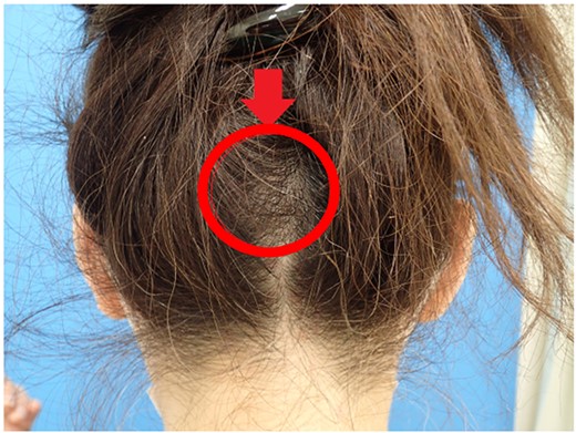 Large palpable mass in the occipital region.