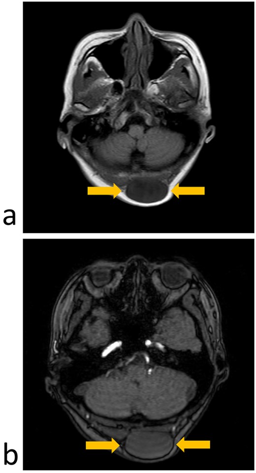 MRI imaging (axial section); (a) T1-weighted image showing a low-intensity signal area under the scalp; (b) T2-weighted images showing an isointense signal of the tumor.
