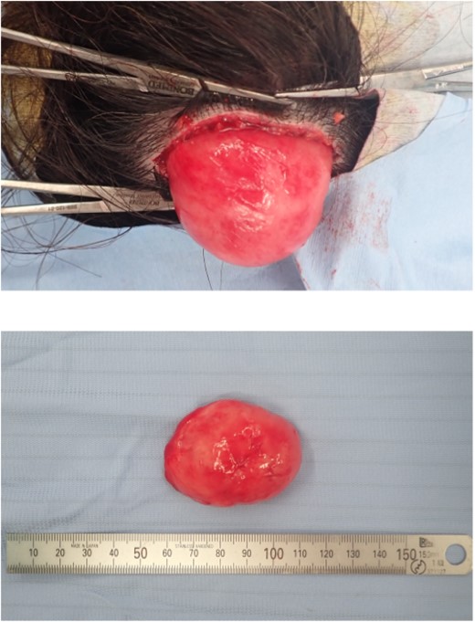 Encapsulated tumor after resection, ~51 × 42 mm in size; no adhesion to the adjacent tissue or vascular involvement.