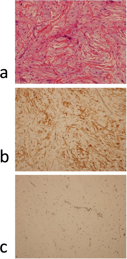 (a) Pathological findings (hematoxylin–eosin stained × 200); there is proliferation of spindle cells with pale nuclei of chromatin along with acidophilic collagen fibers against a background of basophilic mucus-like stroma; immunohistochemistry results (× 200); (b) positive staining for CD 34; (c) positive staining for Rb1.