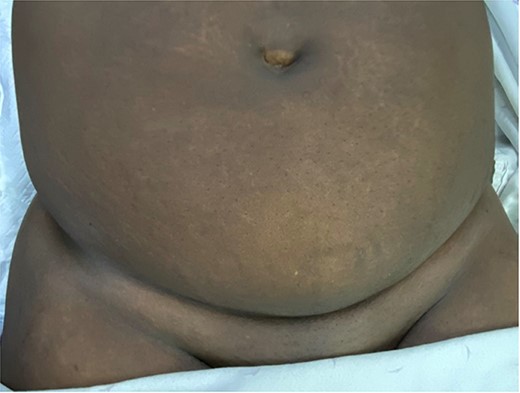 Pfannenstiel incisional hernia (front view of the abdomen).