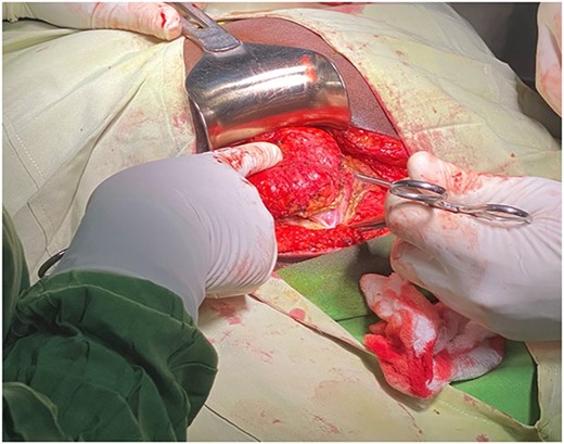 Hernia sac protruding through the splitting fibers of the rectus muscle.