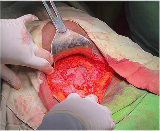 Inlay mesh fixation ended.