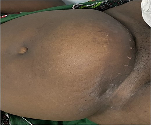 Front view of the patient with the seroma of the wound.