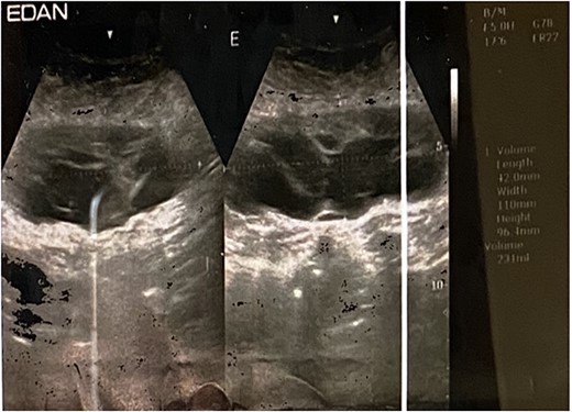 Ultrasound showing fluid collection.