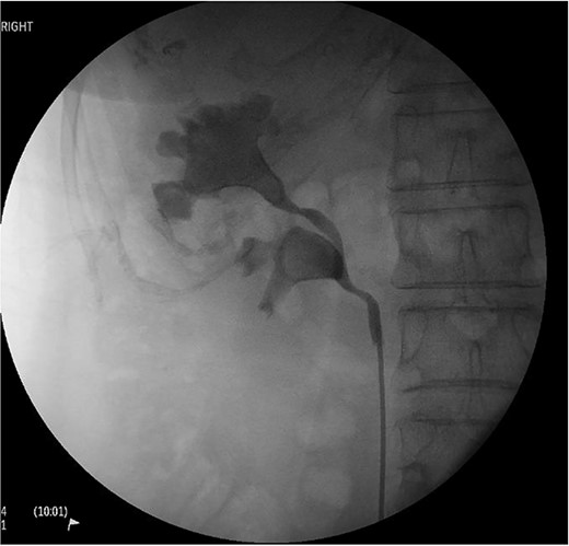 Right retrograde pyelogram as part of pre-operative workup and diagnosis. Evidence of a proximal bifid ureter with distal confluence can be seen, and the presence of two large staghorn calculi are clearly seen in both the upper and lower moity renal pelvis.