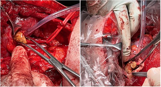(Left) Removal of the lower moity staghorn calculi via a pyelotomy at the base of the right inferior moity renal pelvis. (Right) Removal of the upper moity staghorn calculi via a posterior parenchymal incision along the bloodline plane of Brodel (between the anterior and posterior segmental branches of the renal artery.