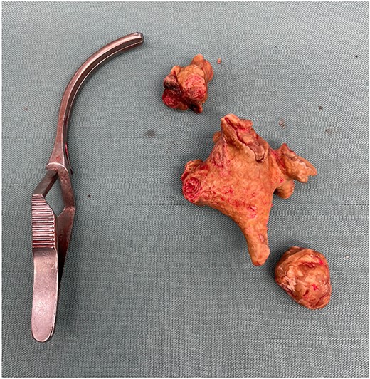Both the upper (with additional fragment above) and lower staghorn calculi specimen placed next to a bulldog vascular clamp for reference.