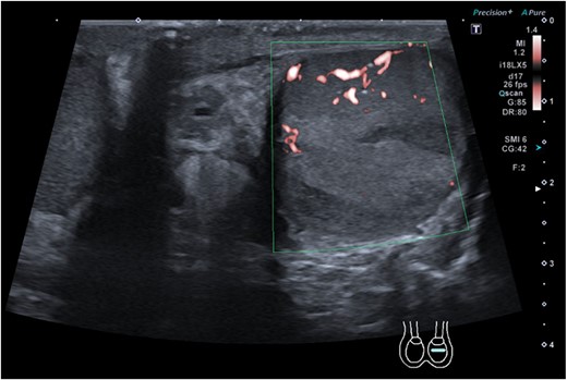 Ultrasound sonography of left testicle demonstrating wedge segmental infarcts which are avascular on colour doppler.