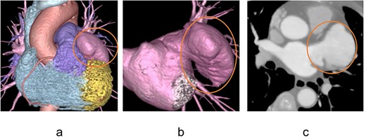 Preoperative contrast-enhanced computed tomography image A large left atrial appendage aneurysm was found, but no internal thrombus is visible.