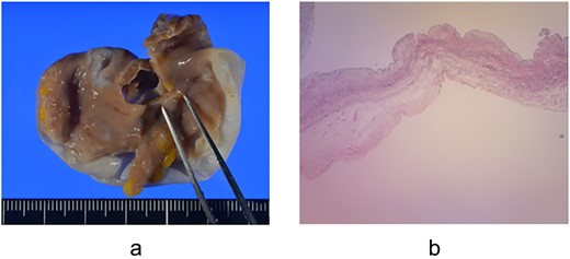 Resected left atrial appendage aneurysm and pathological specimen (a) The size of the left atrial appendage aneurysm was 5.5 × 4.0 × 1.5 cm, and no thrombus was observed inside; (b) Pathological examination showed preserved but thinning myocardial tissue and mucous degeneration.