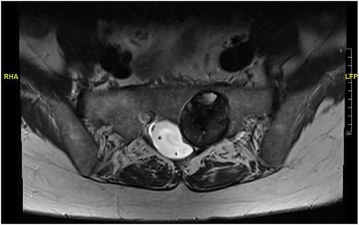 T2-weighted axial images of the MRI scan.