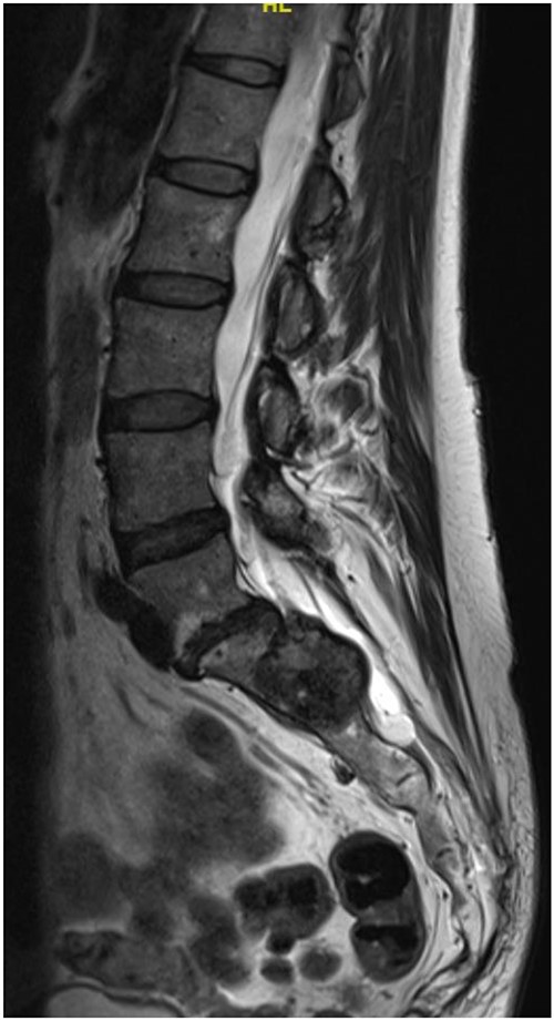 T2-weighted sagittal images of the MRI scan.