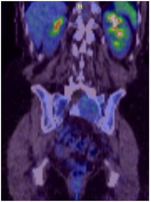 Coronal image of 18F-FDG PET/CT scan showing MS.