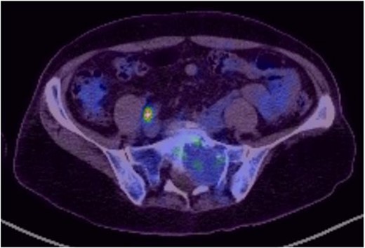 Axial image of 18F-FDG PET/CT scan showing MS.