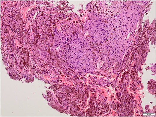 Histopathology slide with the tumour being composed of fascicles and pleomorphic cells obscured by the melanin pigment.