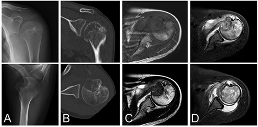 Chondroblastoma in left humerus of a 13-year-old female. Plain radiographs (A) and commuted tomography (CT) scans (B) show osteolysis with marginal sclerosis in the humeral epiphysis. Calcification is visible in CT images (B). The lesion has homogenous low signal intensity on the T1-weighted image (C-top) and heterogeneous signal intensity on the T2-weighted image (C-bottom) using magnetic resonance images.