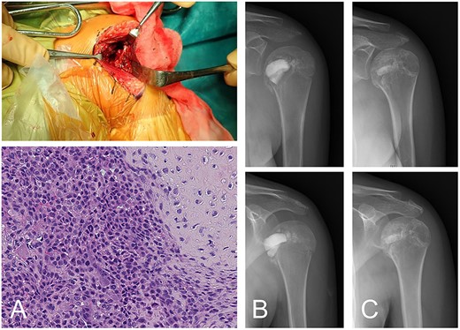 Chondroblastoma in left humerus of a 13-year-old female (same case as Fig. 1). The lesion was curetted via a deltopectoral approach (A-top). Histology shows cartilaginous differentiation with the proliferation of round or polygonal cells and a well-defined cytoplasm and eccentric nucleus (A-bottom). Osteoclast-like giant cells were also observed. The cavity after curettage was filled with low-porosity β-TCP blocks and normal porosity particles (B). The implanted β-TCP was stable and by 2 years 5 months after surgery was almost entirely incorporated into the surrounding bone (C).