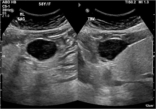 Homogonous hypoechoic lesion anterior to the left hepatic lobe. Color doppler images (not shown) shows internal blood flow.